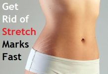 how to get rid of stretch marks fast