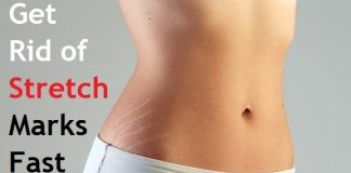 how to get rid of stretch marks fast