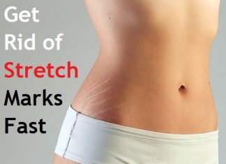 how to get rid of stretch marks fast