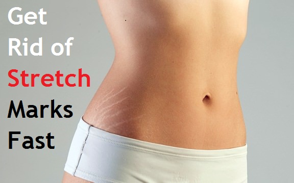 how to get rid of stretch marks fast