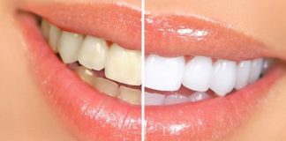 how to whiten your teeth