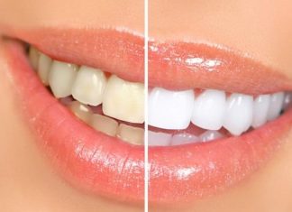 how to whiten your teeth