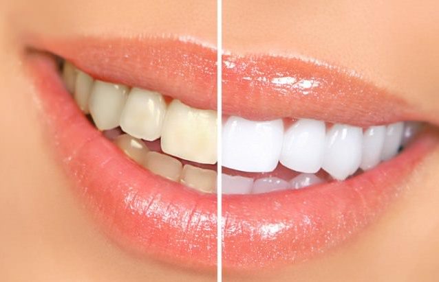 how to whiten your teeth