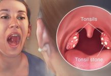 how to remove tonsil stones