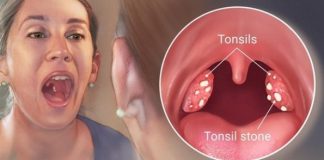 how to remove tonsil stones