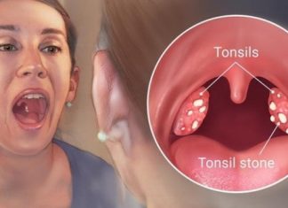 how to remove tonsil stones