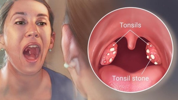 how to remove tonsil stones