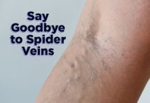 how to get rid of spider veins fast