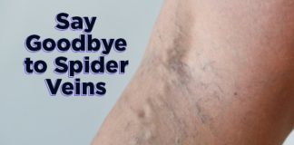 how to get rid of spider veins fast