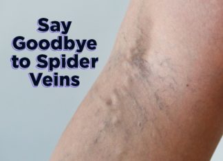 how to get rid of spider veins fast