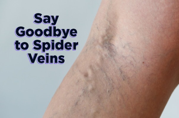 how to get rid of spider veins fast