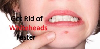 how to get rid of whiteheads