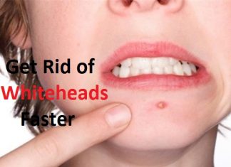 how to get rid of whiteheads