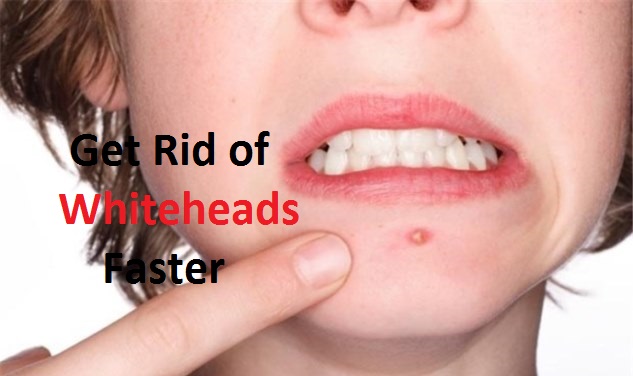 how to get rid of whiteheads