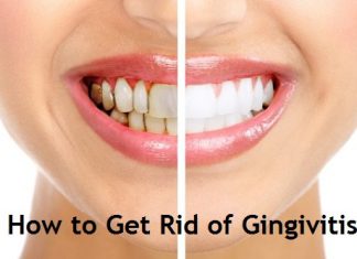 how to get rid of gingivitis