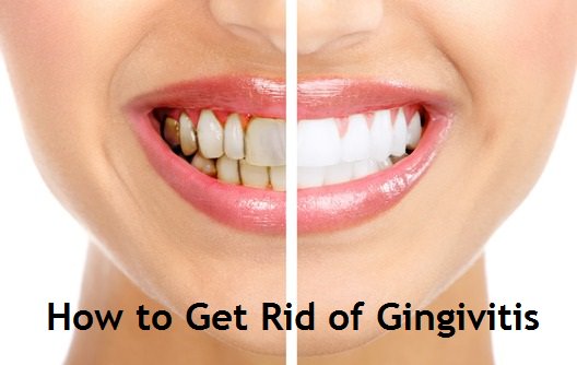 how to get rid of gingivitis