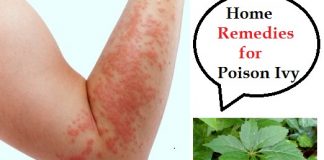 Home remedies for poison ivy