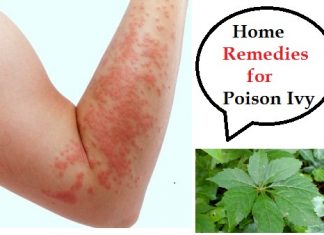 Home remedies for poison ivy