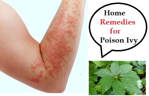 Home remedies for poison ivy