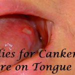 Remedies for Canker Sore on Tongue