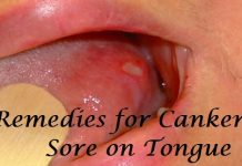 Remedies for Canker Sore on Tongue