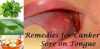 Remedies for Canker Sore on Tongue