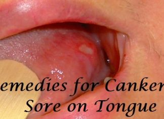 Remedies for Canker Sore on Tongue