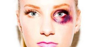 how to get rid of black eye