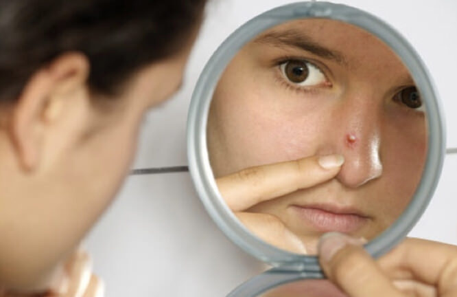 How to get rid of a pimple overnight