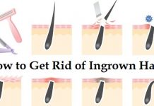 how to get rid of ingrown hair