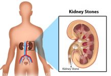 How to prevent kidney stones