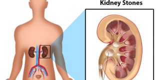 How to prevent kidney stones