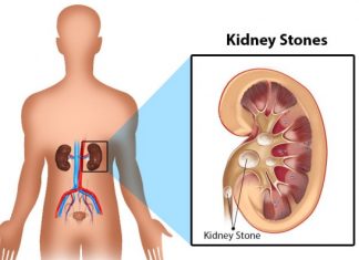 How to prevent kidney stones