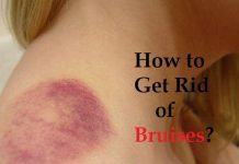 How to get rid of bruises