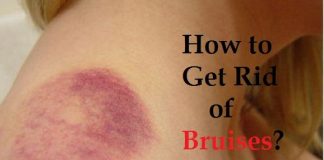 How to get rid of bruises