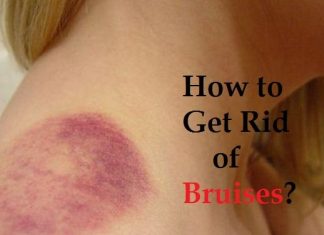 How to get rid of bruises