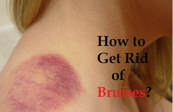 How to get rid of bruises