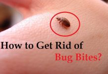 how to get rid of bug bites