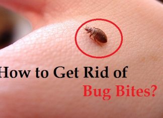 how to get rid of bug bites