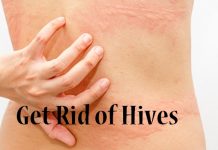 how to get rid of hives