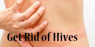 how to get rid of hives