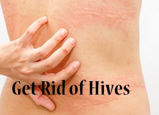 how to get rid of hives