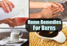 home remedies for burns