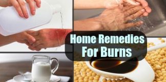 home remedies for burns