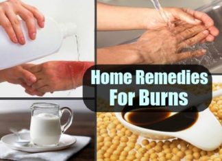 home remedies for burns