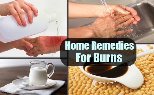 home remedies for burns