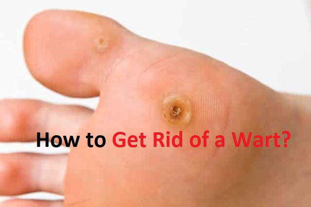 how to get rid of a wart