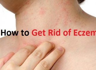 how to get rid of eczema