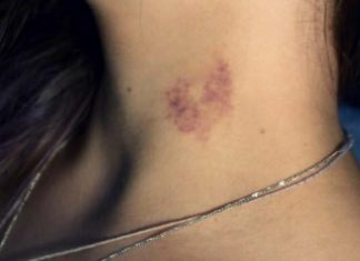 how to get rid of hickeys fast