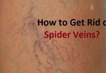 how to get rid of spider veins